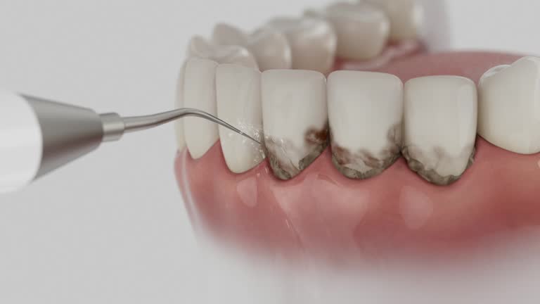 Trusted Wisdom Tooth Removal service in Billington Heights, NY - Dentist Open Now